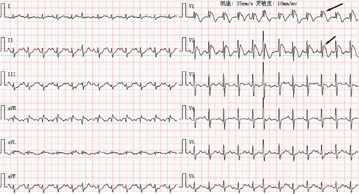 Twelve-lead electrocardiography (ECG) when febrile. Note the pseudo-right bundle branch pattern and ‘coved’ ST-segment elevations in V1, V2 leads (arrows) consistent with a Type 1 Brugada pattern.