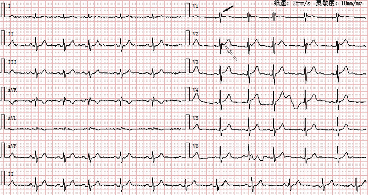 Initial ECG on presentation several hours after syncope. Note the pseudo-right bundle branch block (solid black arrow) and the saddleback ST-segment elevation in V2 lead (hollow arrow) consistent with a Type 2 Brugada pattern.