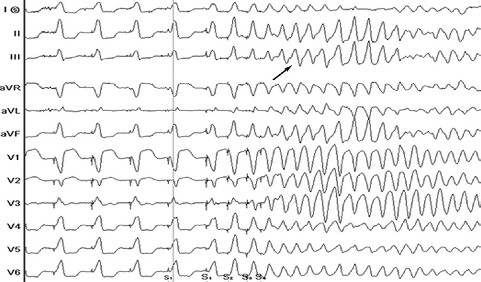 Electrocardiography of induced ventricular fibrillation. Note the ventricular fibrillation (arrow) could be induced by vigorous programmed stimulation (S1S2S3S4, 500/300/300/250 ms) from the right ventricular apex. Defibrillation with 200 joules was successful.