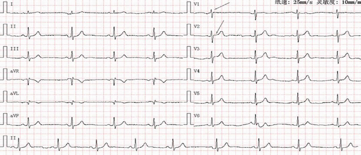 Twelve-lead ECG during the follow up period. During the follow up period, repeated ECG was normal like, especially ST segment in V1, V2 leads (arrows).