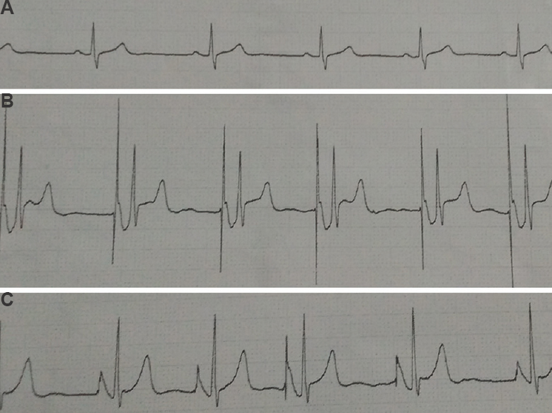 Three electrocardiograph P wave forms seen during catheterization in the electrocardiograph test group. (A) Blunt, low-amplitude, P waves. (B) Biphasic P waves. (C) High-amplitude P waves (50 or 90% of QRS amplitude).