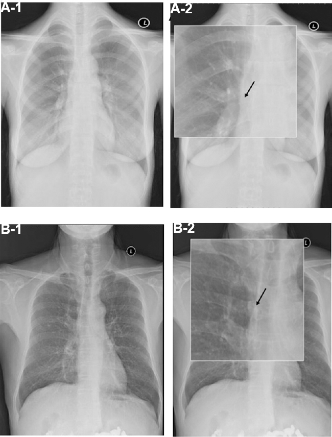 Chest radiographs of patients from the two groups. Arrow indicates the position of the catheter tip. Tip location flush with the 7th intercostal in a patient from the electrocardiograph test group. A-1 (chest radiograph); A-2 (magnified image). Tip location flush with the 5th intercostal in a patient from the control group. B-1 (chest radiograph); B-2 (magnified image).