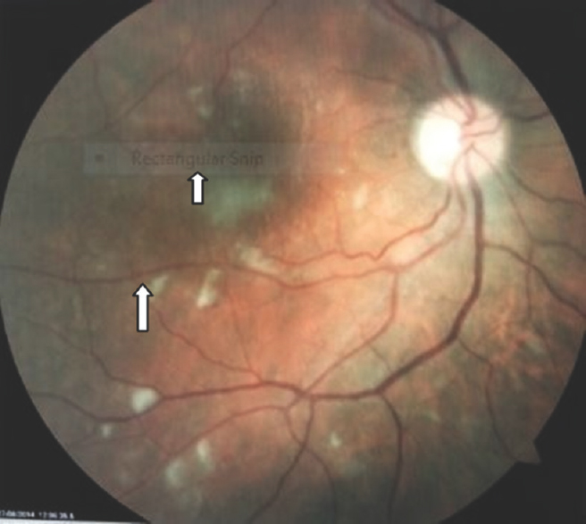 Multiple cotton wool spots in a patient with HIV retinopathy (arrows).
