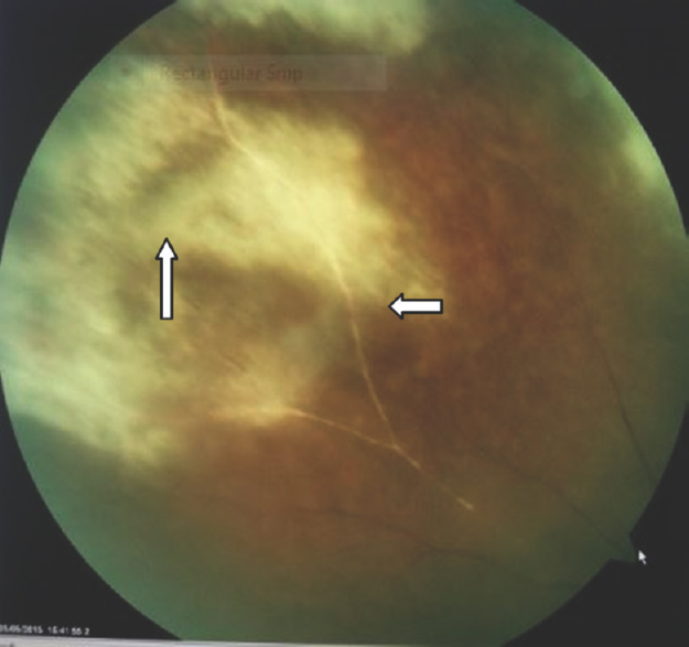 Cytomegalovirus retinitis in a patient with HIV. Arrows point towards extensive area of retinal necrosis. Also visible is the typical frosted branch angitis appearance of the vessel.