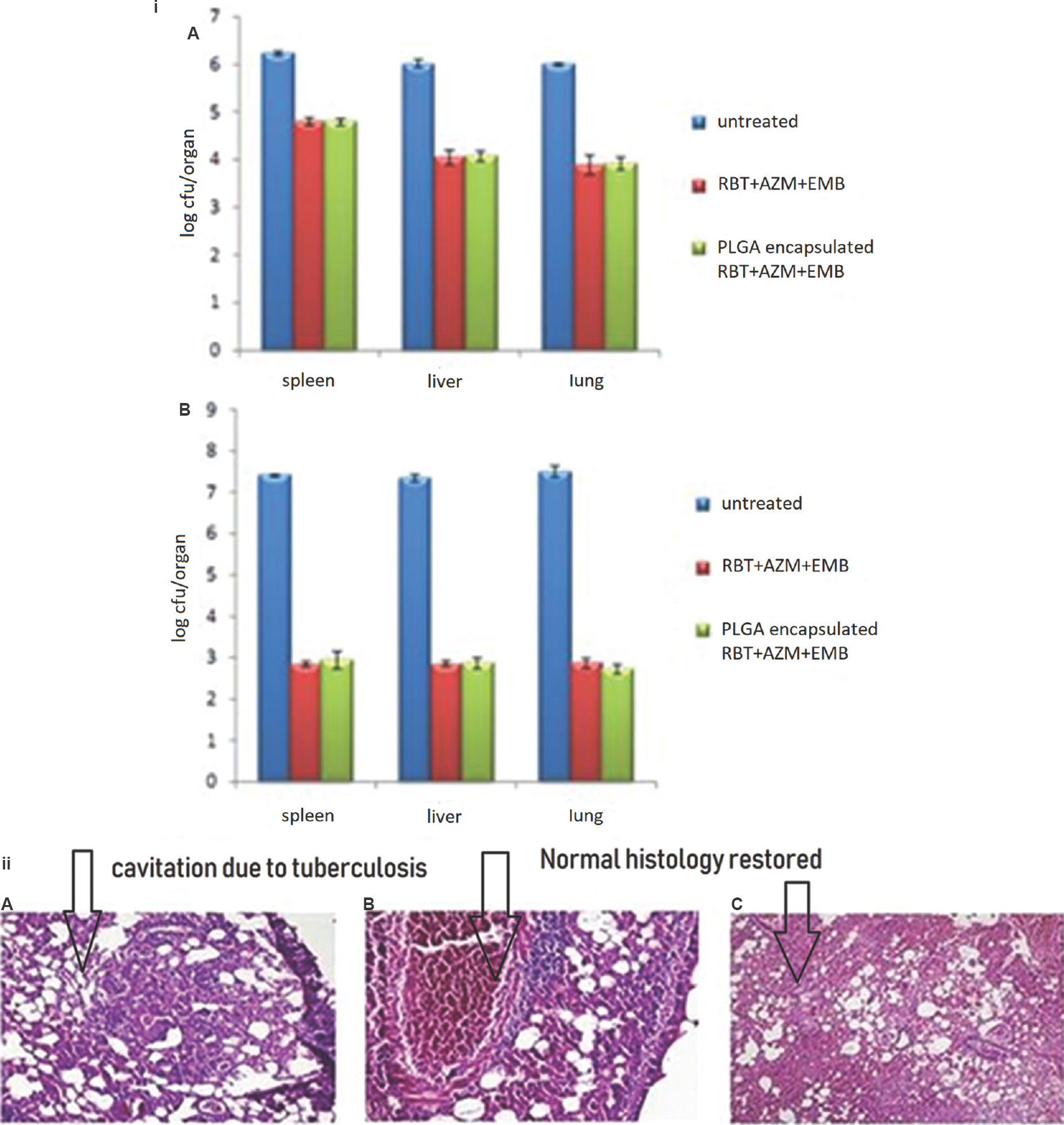 (i) Chemotherapeutic efficacy of Mycobacterium avium drugs in free or poly (DL-lactide-co-glycolide) nanoparticle-encapsulated form against Mycobacterium avium infections after (A) four weeks and (B) eight weeks of chemotherapy. Values are mean±standard deviation of three animals. (ii) Lung H&E histopathology after eight weeks of chemotherapy: (A) untreated groups (100 ×), (B) free drugs group (200 ×) and (C) poly (DL-lactide-co-glycolide) nanoparticle-encapsulated drugs group (100 ×).