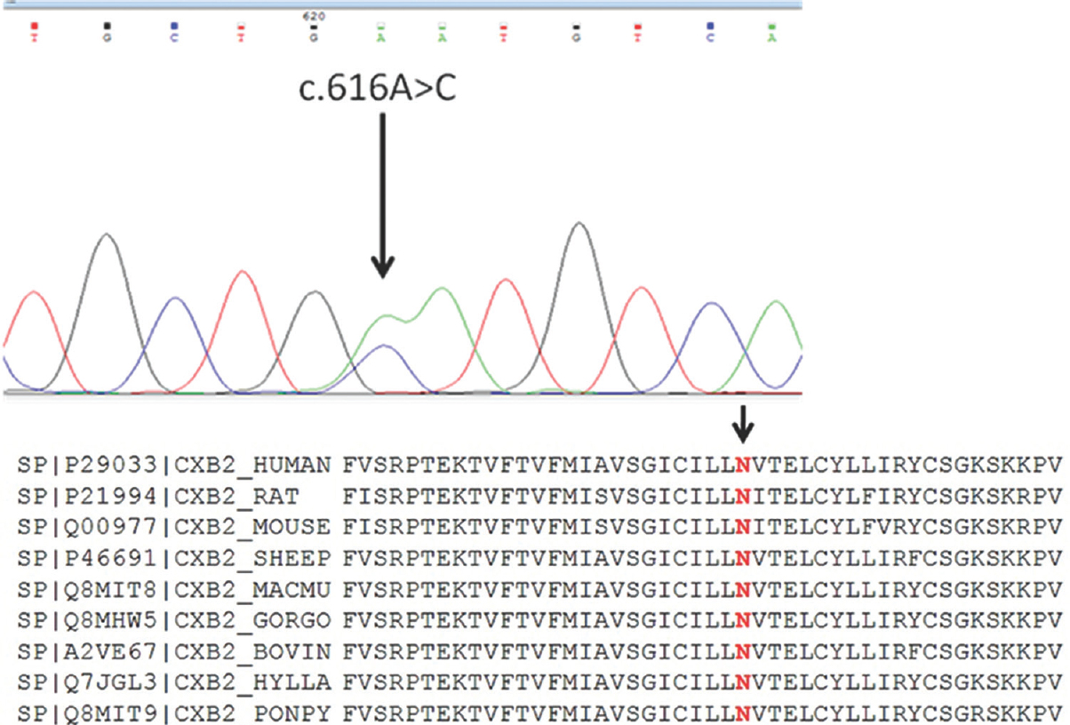 Electropherogram showing heterozygous c.616A>C (p.Asn206His) change and protein sequence alignment showing conservation of amino acid asparagine at position 206 across the species.