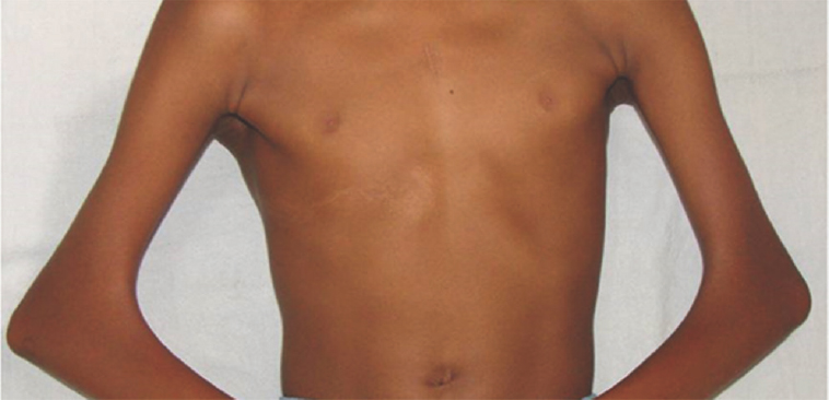 Clinical picture showing antecubital pterygium on both sides and flexion contractures.