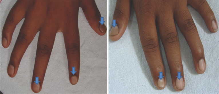 Clinical picture showing slight discoloration and dystrophy of nails as mild ridges mainly in the thumbs, index and middle fingers on both sides (arrows).