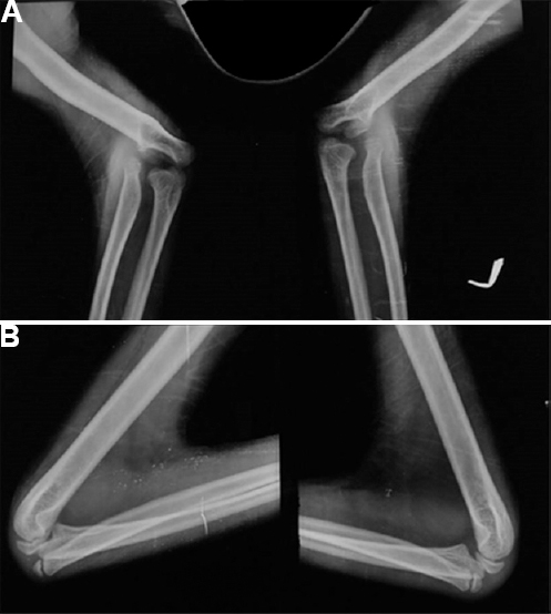 X-ray of elbows in (A) anteroposterior and (B) lateral view showing dysplasia of the bilateral radial heads and lateral humeral condyles.