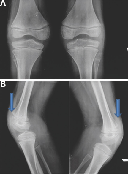 X-ray of both knees in (A) anteroposterior and (B) lateral view showing the absence of patellae (arrows).