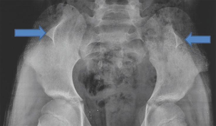 X-ray of pelvis revealing bilateral iliac horns (arrows).