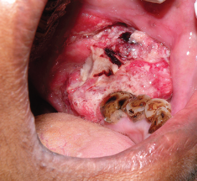 Oral squamous cell carcinoma in a patient addicted to gutka. Tumour arising from retromolar region has spread to the buccal sulcus. The figure demonstrates features of an exophytic growth with ulceration and necrosis.