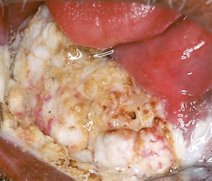 Verrucous carcinoma in oral cavity of a patient in a tobacco chewer. This is an advanced tumour with a typical verrucoid appearance.