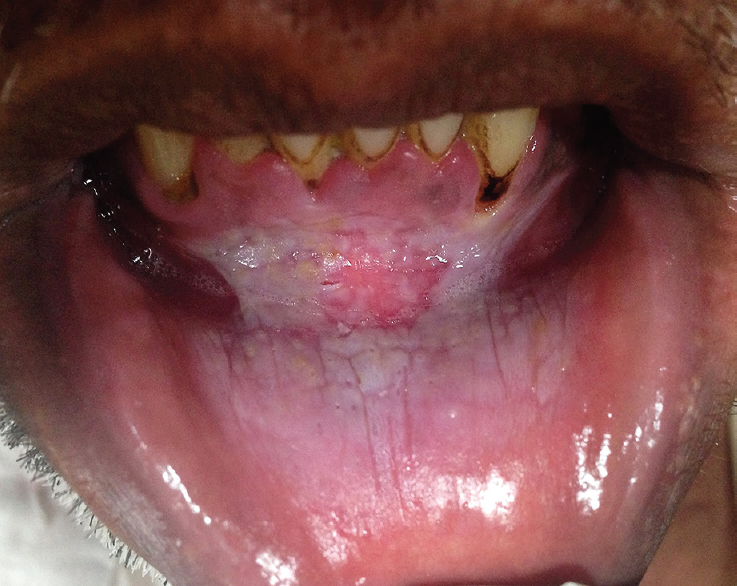Lower labial sulcus of a patient showing tobacco pouch keratosis in places where the quid has been retained for long periods.