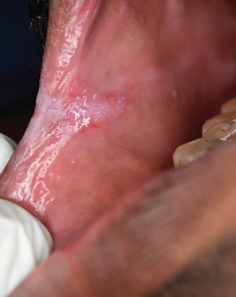 Erythroleukoplakia with candidal infection. This is mixed red and white lesion and has a worse prognosis than homogeneous leukoplakia.