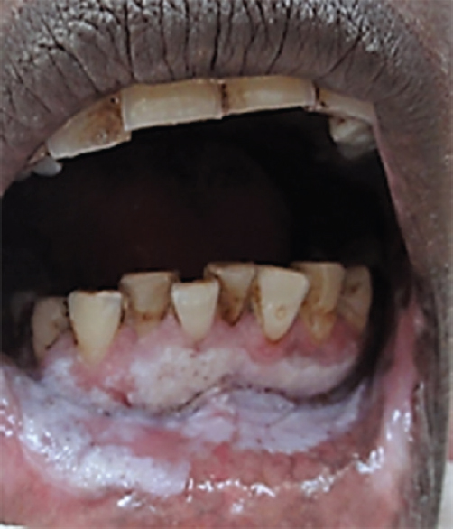 Proliferative verrucous leukoplakia. Thick white plaques are noted affecting several sites, gingiva, alveolar mucosa, the sulcus and spreading to lower lip.