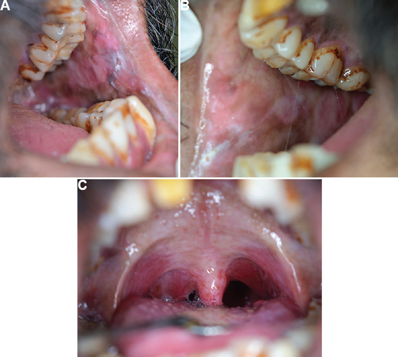 Oral submucous fibrosis, (A) left buccal mucosa, (B) right buccal mucosa, (C) palate. The buccal mucosae show loss of elasticity and fibrous banding. The palatal arch shows fibrosis.