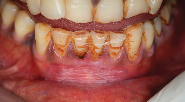 Tooth staining. These extrinsic stains are due to long term betel quid with tobacco use.