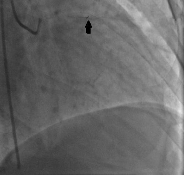 An angiographic image of the fractured wire shows an entrapped guide wire in the left anterior descending. The arrow shows proximal tip of the remnant guide wire.
