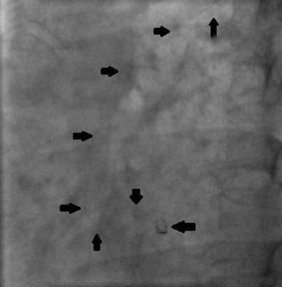 The angiography shows the fractured wire in the left anterior descending artery, and the arrows show the extension of the same to the ascending aorta.