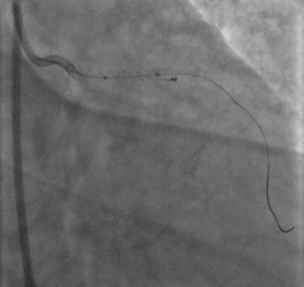 Spiral shape of the remnant fractured guide wire in the left anterior descending artery. Video available at ijmr.org.in.