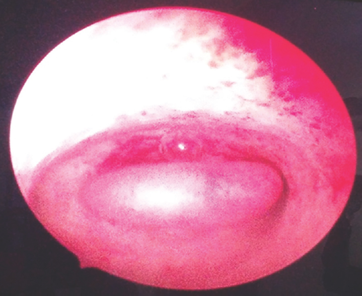 Hysteroscopic view of endometrial polyp.