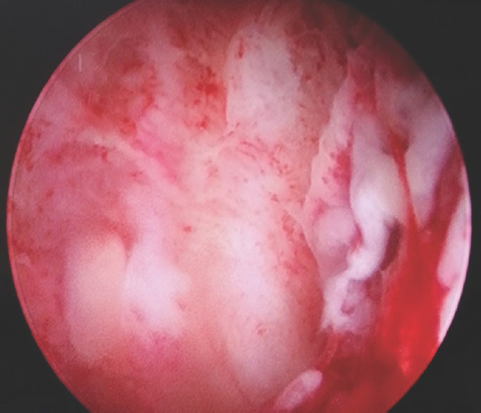 Hysteroscopic view of endometrial hyperplasia.