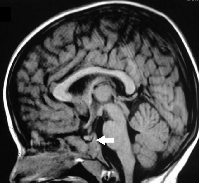 Magnetic resonance imaging of the brain showing the absence of posterior pituitary bright spot (arrow).