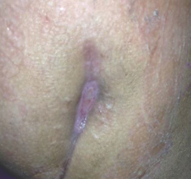 Sinus on the right gluteal region.
