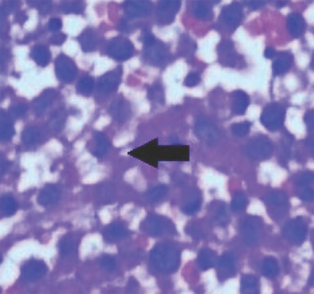 Biopsy of induration wall showing Langerhans cell with blue reniform nucleus (arrow) (Hemotoxylin and Eosin, ×20).