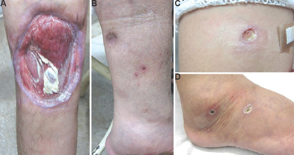 (A) A single well-defined ulcer of size 7 cm present over medial aspect of the right leg with sloping margins, floor of the ulcer is clean with underlying muscles clearly visible. (B) Scars of the previous ulcers visible over the course of superficial veins. (C & D) Multiple well-defined punched out ulcers with indurated firm base, erythematous margins with perceptible violaceous hue, slough present on the floor with little granulation tissue. Ulcers range in size from 7 mm to 1.5 cm diameter and are present over both arms and legs with surrounding pedal and hand oedema.