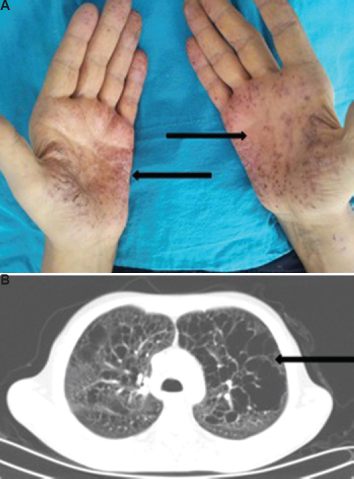 (A) Erythematous-vesicle-squamous-crusty lesions on palms (arrows). (B) Computed tomography chest showing bullous emphysematous lesions in both lungs (arrows).
