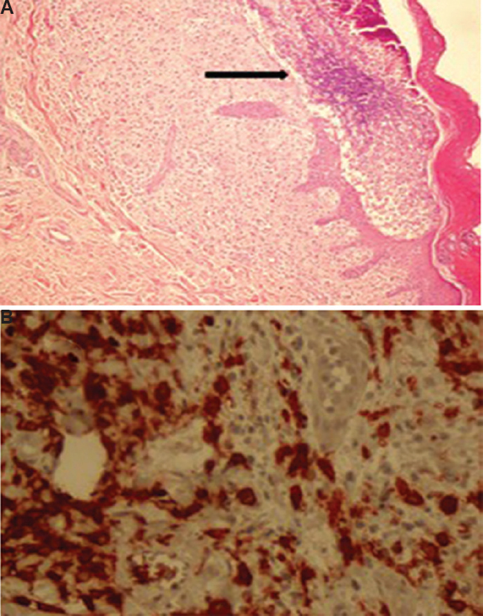 (A) Epidermal hyperkeratosis with intra- and subepidermal pustules (arrow); and histiocytes, eosinophilic infiltration of inflammatory cells containing polymorphs and congested capillaries with extravasated red blood cell (H and E, ×100). (B) Positive immunohistochemistry for antigen CD1a (H and E, ×CD1a, ×400).