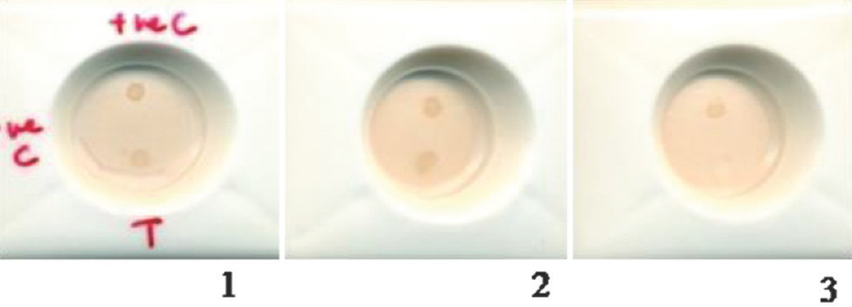 Detection of Shigella dysenteriae culture lysates by rapid flow-through assay. Upper dot represents positive controls. Capture antibody anti-recombinant Shiga toxin B-purified mouse immunoglobulin G (500 ng/cassette); revealing antibody anti-recombinant Shiga toxin B-purified rabbit immunoglobulin G 500 ng/cassette) Cassette no.1. Shigella dysenteriae culture lysate from Christian Medical College, Vellore; 2. Shigella dysenteriae culture lysate from of National Institute of Cholera and Enteric Diseases, Kolkata; 3. Escherichia coli SG13009 (negative control).
