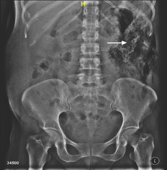 X-ray kidney ureter bladder showing gaseous radio-dense shadow occupying left side of abdomen (arrow).