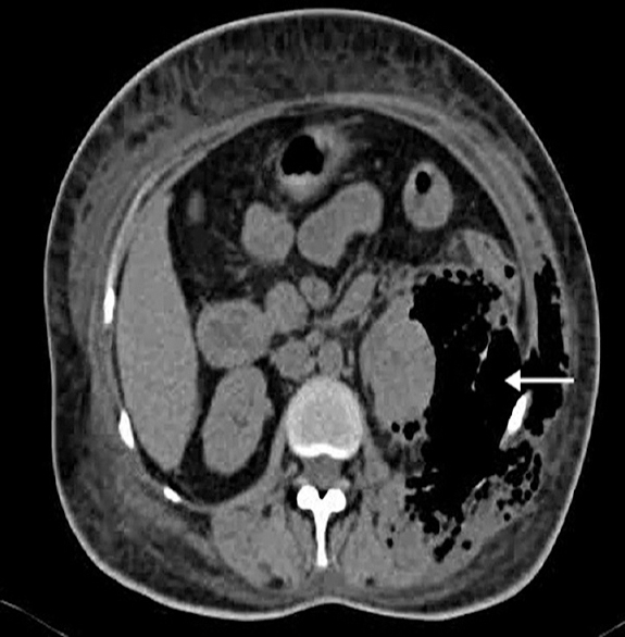 Cross-section computed tomographic images showing gas in perinephric space (arrow).