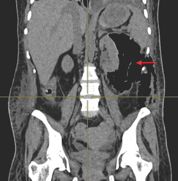 Coronal reformatted computed tomographic image showing destruction of the left kidney with emphysematous changes, retropneumoperitoneum and subcutaneous emphysema (arrow).