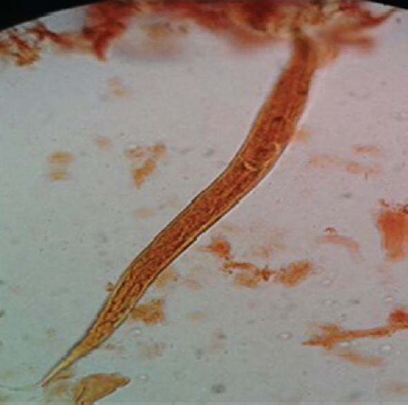 Filariform larvae, L3 of Ancylostoma duodenale and Necator americanus in iodine stain obtained from agar plate culture.
