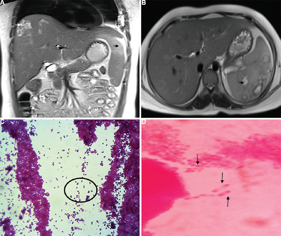 (A) Half-Fourier Acquisition Single-Shot Turbo Spin-Echo coronal abdomen magnetic resonance imaging showing hepatic and splenic bright signal intensities suggestive of abscesses (black and white arrows). (B) Half-Fourier Acquisition Single-Shot Turbo Spin-Echo axial abdomen magnetic resonance imaging showing hepatic and splenic bright signal intensities suggestive of abscesses (arrow). (C) Gram stain of splenic pus aspirate (×40) showing Gram-negative bacilli, bipolar stained with a safety pin appearance (circle). (D) Splenic aspirate pus Gram stain (×100) oil immersion field shows many bipolar-stained (pink-coloured) Gram-negative bacilli giving a safety pin appearance.