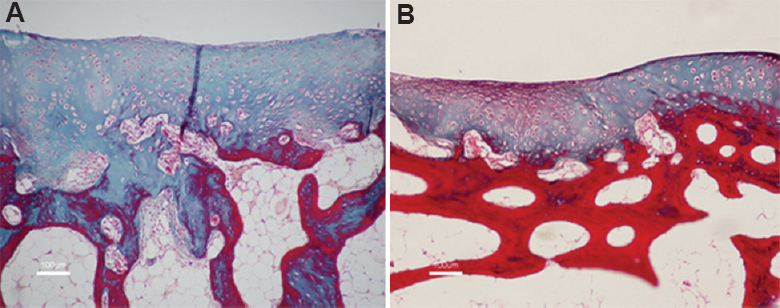 Histology of the cartilage (Masson's Trichrome, ×10) treated with (A) autologous chondrocytes; (B) allogenic chondrocytes showing the presence of hyaline and fibrocartilage formation with good integration with adjacent normal cartilage.