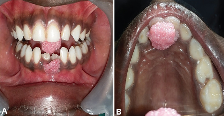 Showing growth with finger-like projections present on anterior mandibular gingiva where the growth of maxilla is contacting (A). Occlusal view of the exophytic pedunculated growth over incisive papilla (B).