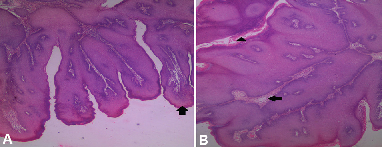 Photomicrograph of haematoxylin and eosin (H and E)-stained section of maxillary growth in ×5 (A) showing multiple, exophytic finger-like projections (arrow) and ×10 (B) showing stratified squamous epithelium with hyperparakeratosis (arrowhead) and connective tissue core (arrow).
