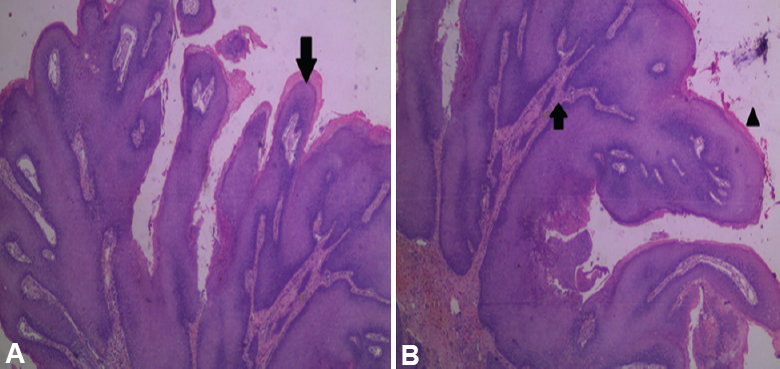 Photomicrograph of haematoxylin and eosin (H and E)-stained section of mandibular growth in ×5 (A) showing multiple, exophytic finger-like projections (arrow) and ×10 (B) showing hyperplastic stratified squamous epithelium (arrowhead) with papillomatosis enclosing core of connective tissue (arrow).