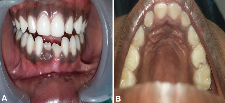A three month post-operative follow up image showing satisfactory healing and no recurrence in anterior mandibular gingiva (A) and over incisive papilla (B).