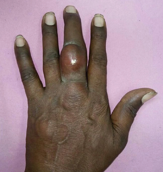 Left hand of patient showing a non-mobile and erythematous nodules on the dorsal aspect of the middle phalanx of the middle finger.