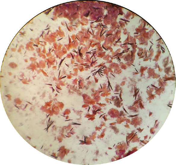 Light microscopy (×40) of the fluid aspirated from the subcutaneous nodule of the left middle finger, showing eosinophilic slender needle-shaped crystals with pointed ends distributed singly and in groups.