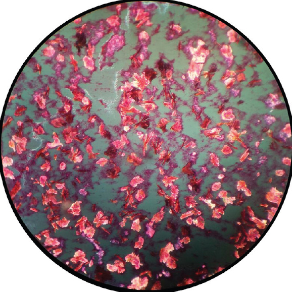 Polarized microscopy of the fluid aspirated from the subcutaneous nodule of the left middle finger, showing strong birefringence of the crystals.