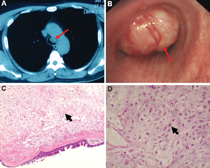 (A) Computed tomography scan showed a lesion in trachea (red arrow). (B) Bronchoscopy found a mass in the trachea (red arrow). (C) Hematoxylin and eosin (H and E), ×10. (D) H and E, ×100 (Glomoid rounded cells and spindle cells were shown with black arrows).