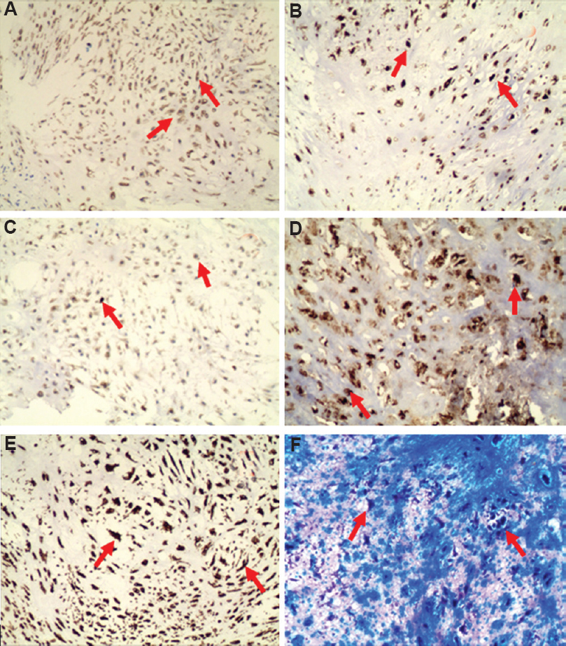 Immunohistochemistry exhibited positive expression (red arrows) of the present tracheal tumor. (A) cytokeratins 8/18 CK8/18 (×100), (3,3'-diaminobenzidine); (B) epithelial membrane antigen (EMA) (×100), (DAB); (C) protein gene product 9.5 (PGP 9.5 ×100), (DAB); (D) S-100 (×100), (DAB); (E) Vimentin (×100), (DAB); (F) Alcian blue periodic acid-Schiff (AB-PAS ×100).