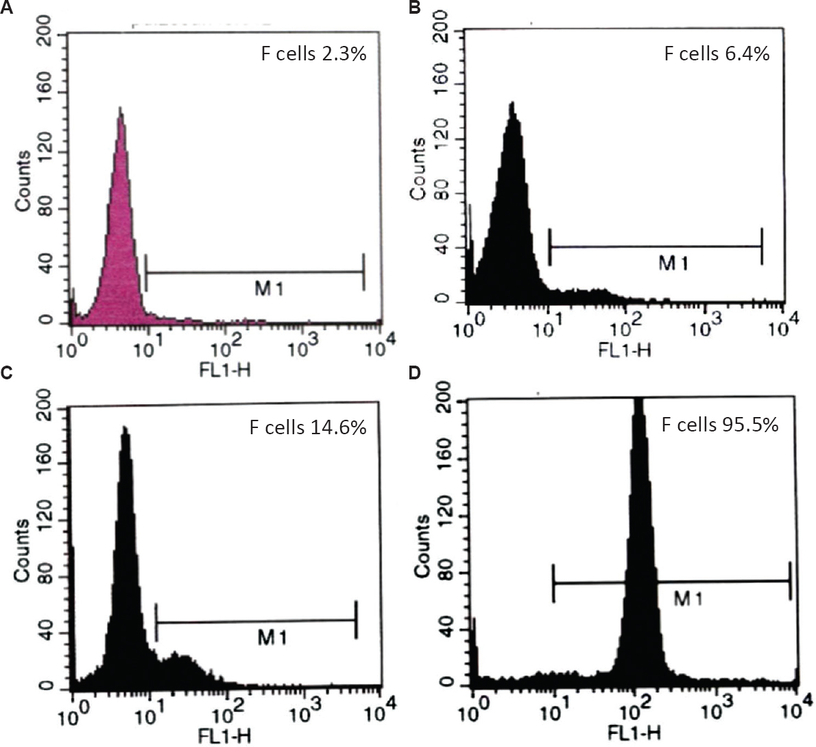 Flow cytometric histogram of F cells in normal (A) and elevated F cell levels (B-D). B and C are representative histograms of moderately high F cell levels observed in adult with heterocellular hereditary persistence of foetal haemoglobin. D is a representative histogram of extremely high F cell levels observed in cord blood.
